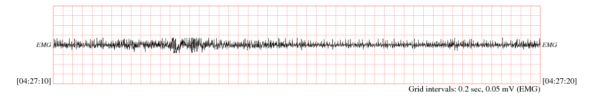 sample electromyogram