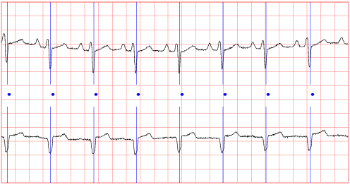 First 5 seconds of record chfdb/chf02