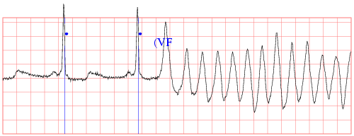 [sample ecg recording]