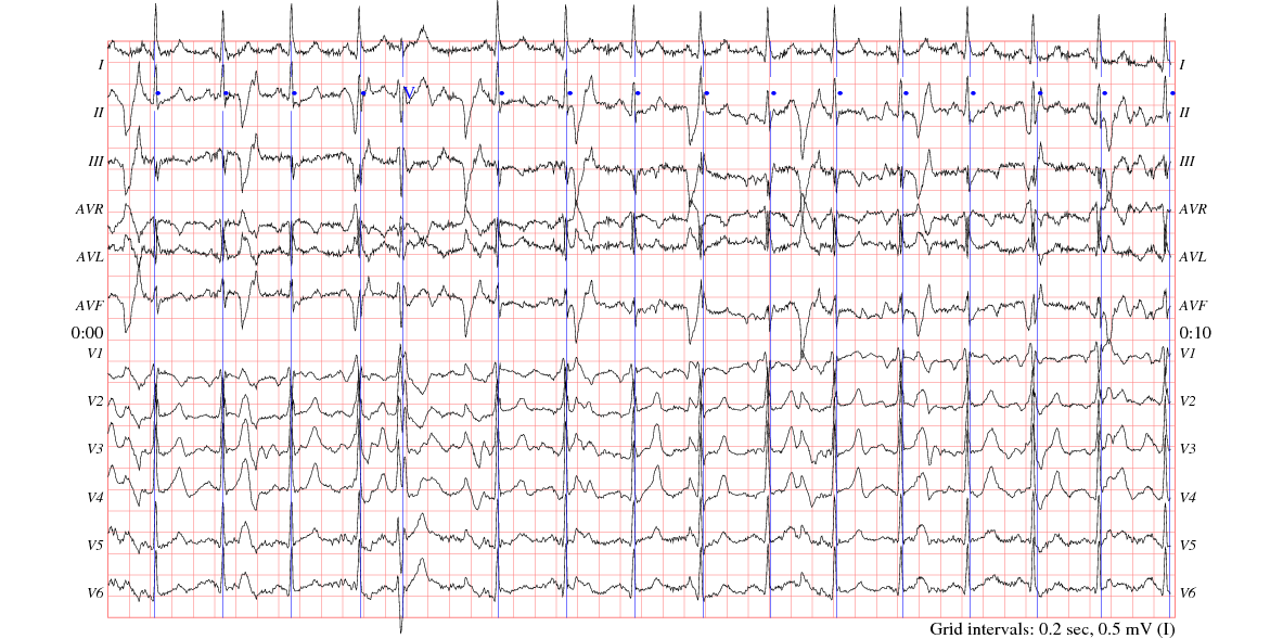 sample from Holter recording