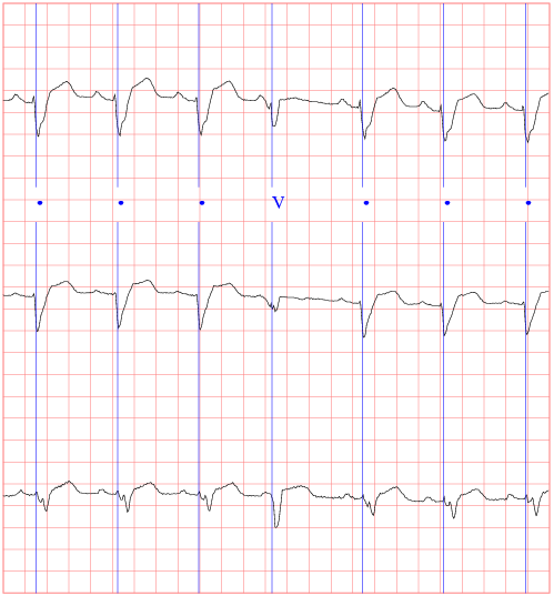 [ sample ECG ]