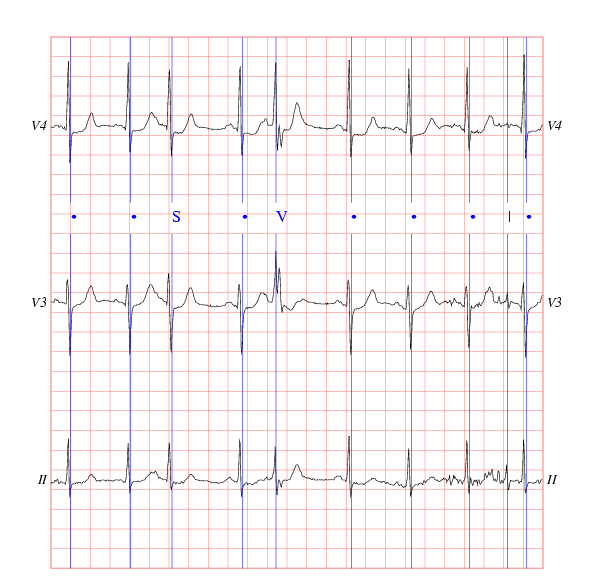 [ sample ECG recording ]
