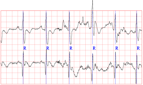 sample ECG recording