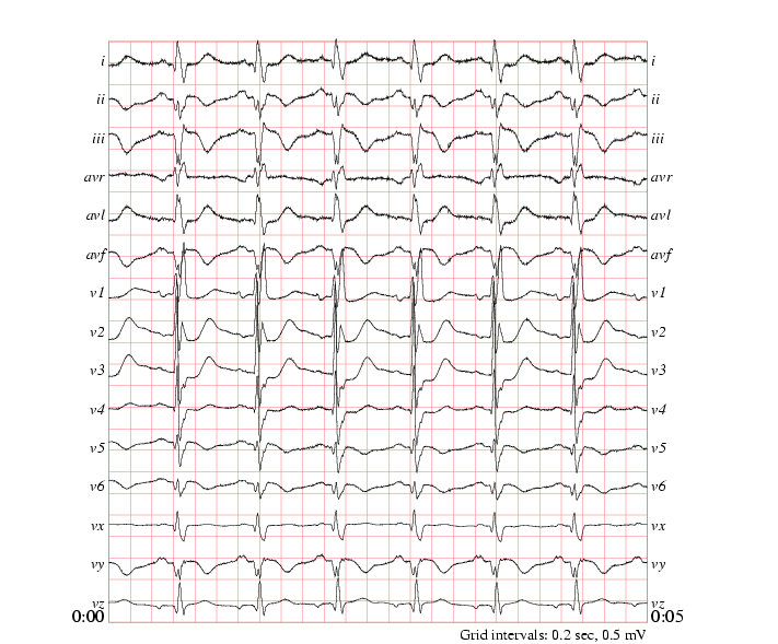 sample ecg