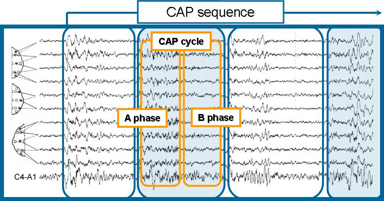 Example of a CAP sequence