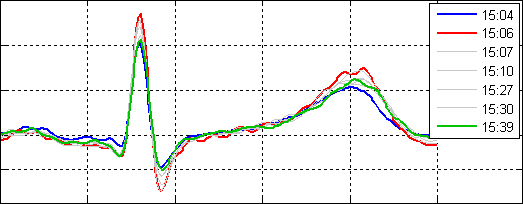 [ECG variations within one hour]