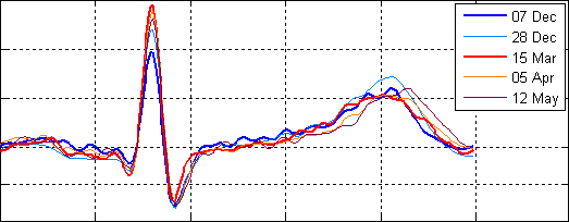 [ECG variations within six months]