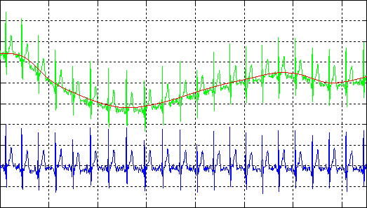 [ECG baseline drift correction 1]