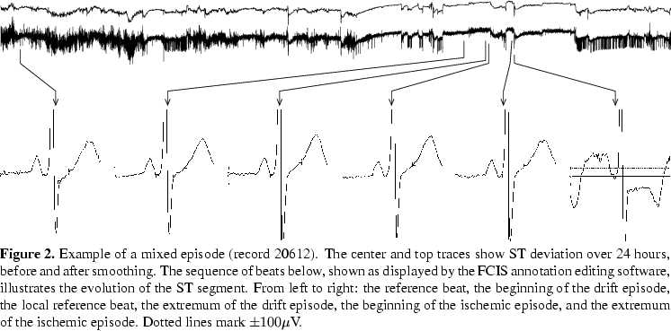 \begin{figure*}{\centering\epsfig{file=fig.ps,width=\linewidth}}
{\centering\eps...
...xtremum of the
ischemic episode. Dotted lines mark $\pm 100 \mu$V.
\end{figure*}