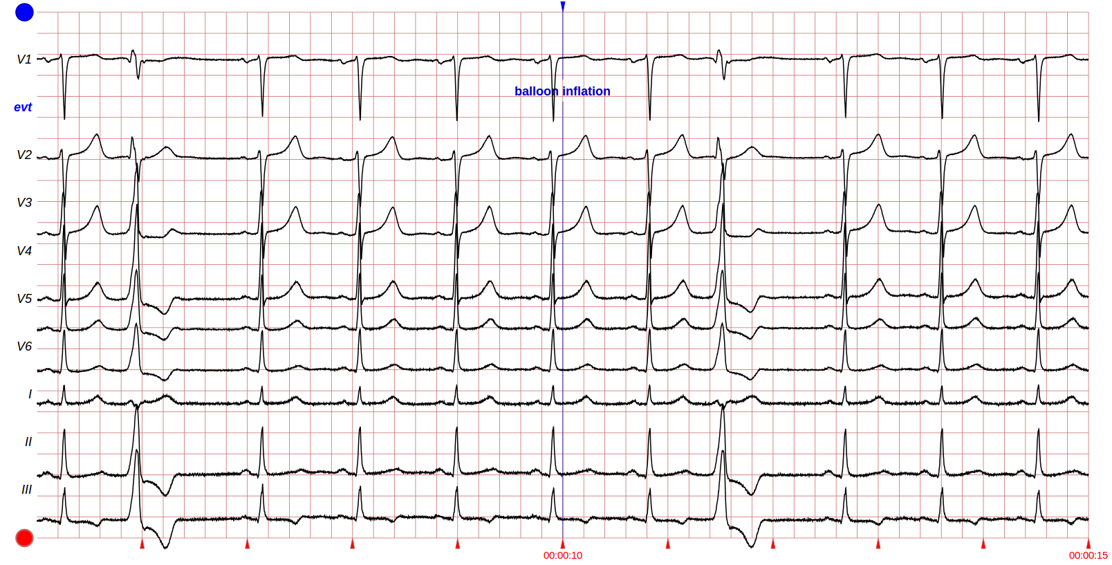 12-Lead ECG Signals