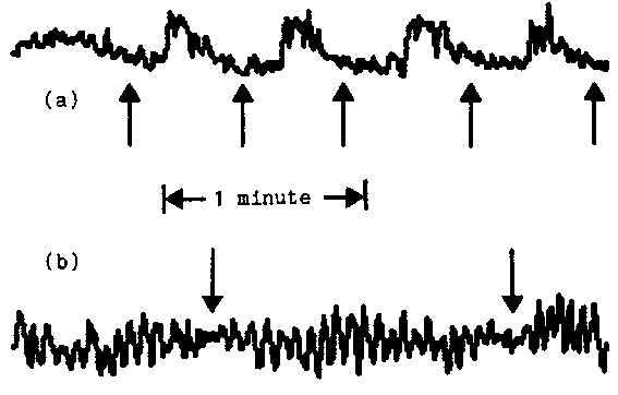 [Obstructive apneas in EDR]