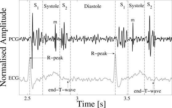 [Example of an ECG-labelled PCG]