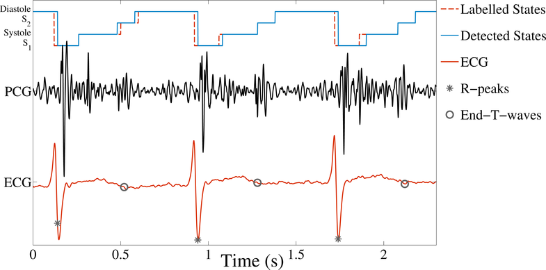 [Example of a segmented PCG]